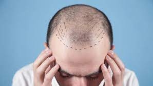 Understanding Hair Transplant Costs at Clinique Internationale, Pune: A Comprehensive Guide