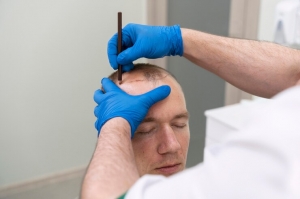 Unlocking Confidence: The Comprehensive Guide to Hair Transplant Cost in Pune